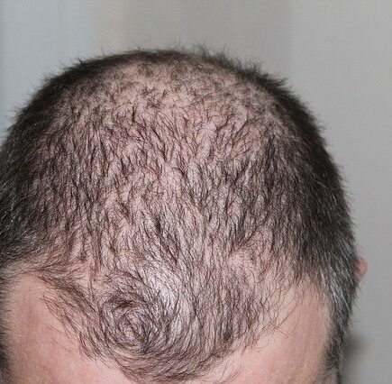 Baldness or hair loss