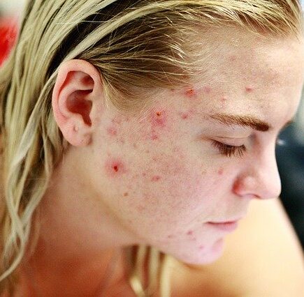 Tips for Acne free skin