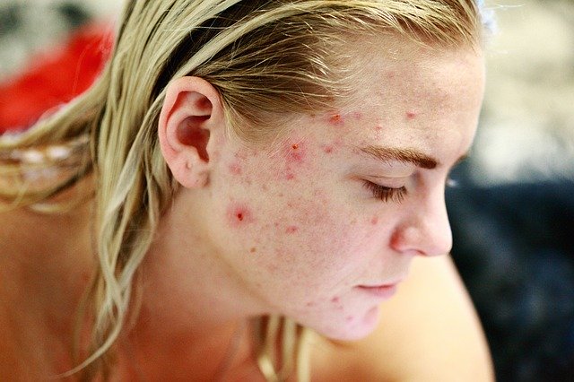 Tips for Acne free skin