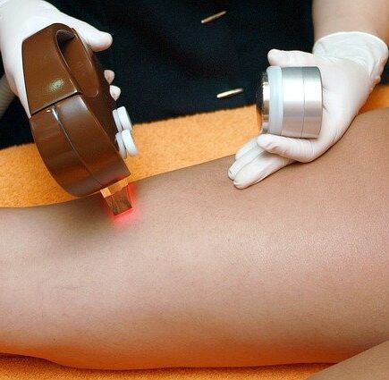 All You Need to Know About Laser Hair Removal