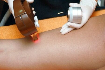 All You Need to Know About Laser Hair Removal