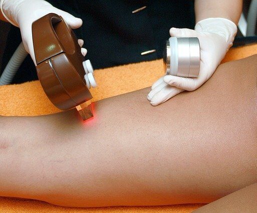 All You Need to Know About Laser Hair Removal