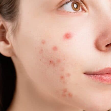 5 tips to reduce acne and scars.