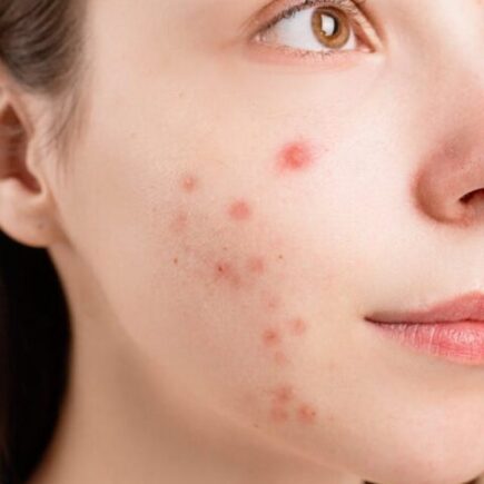 7 Mistakes When Treating Acne