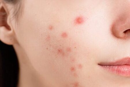 7 Mistakes When Treating Acne