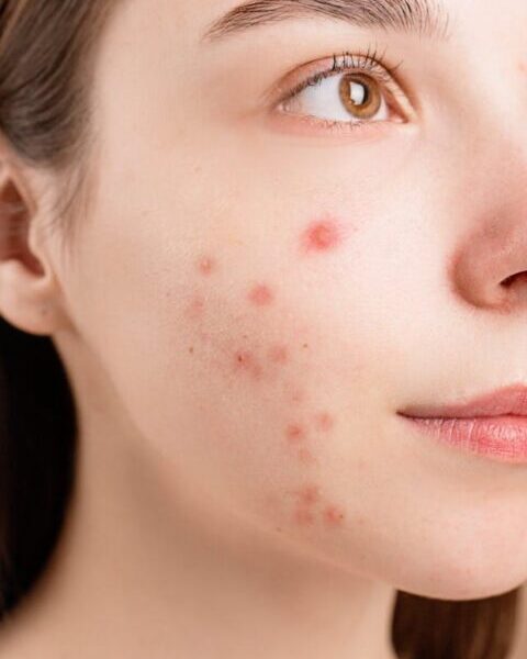 7 Mistakes When Treating Acne